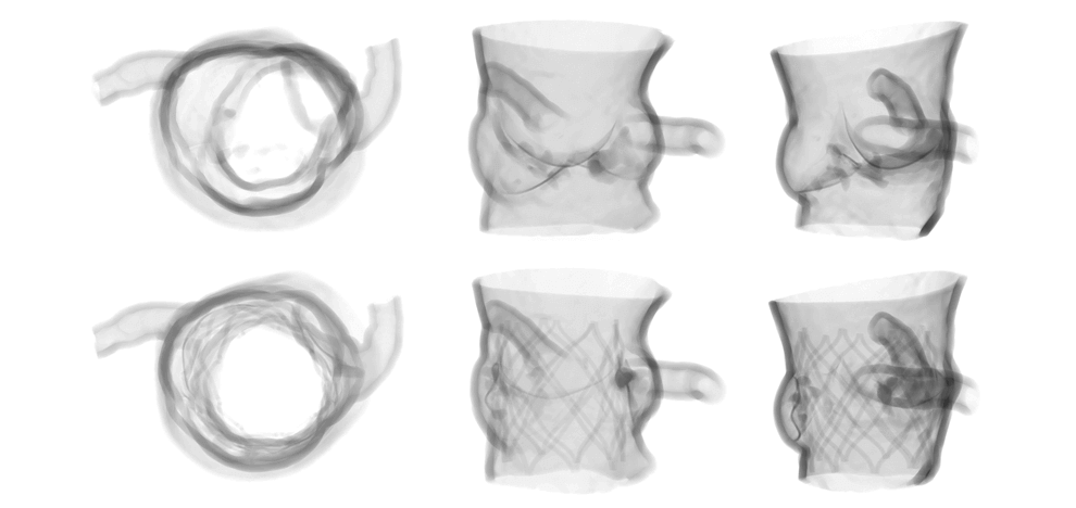 pre-procedural-fit-testing-transcatheter-aortic-valve-replacement-tavr-valves-using-parametric-modeling-3d-printing-11 pre-procedural-fit-testing-transcatheter-aortic-valve-replacement-tavr-valves-using-parametric-modeling-3d-printing-11